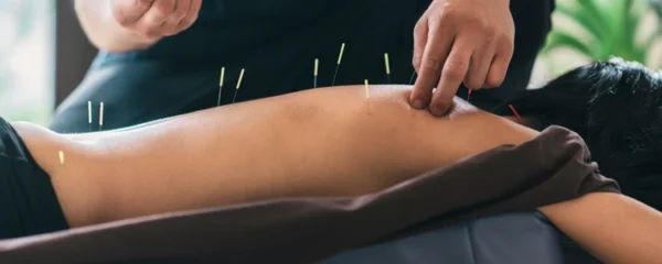 @acupuncture